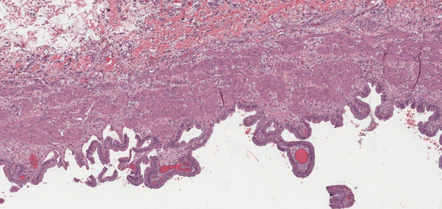 Gall Bladder Pathology